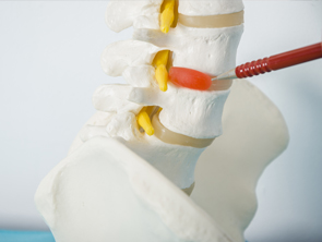 La technique Cox pour les cas d’hernie discale et de sténose spinale