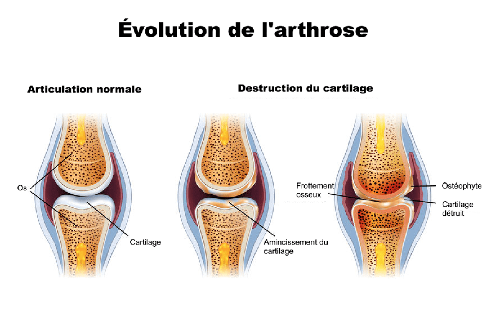 Évolution de l'arthrose
