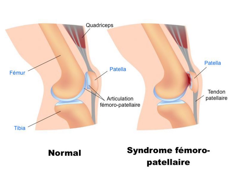 Syndrome fémoro patellaire | Chiropraticien à Québec | Michael ...