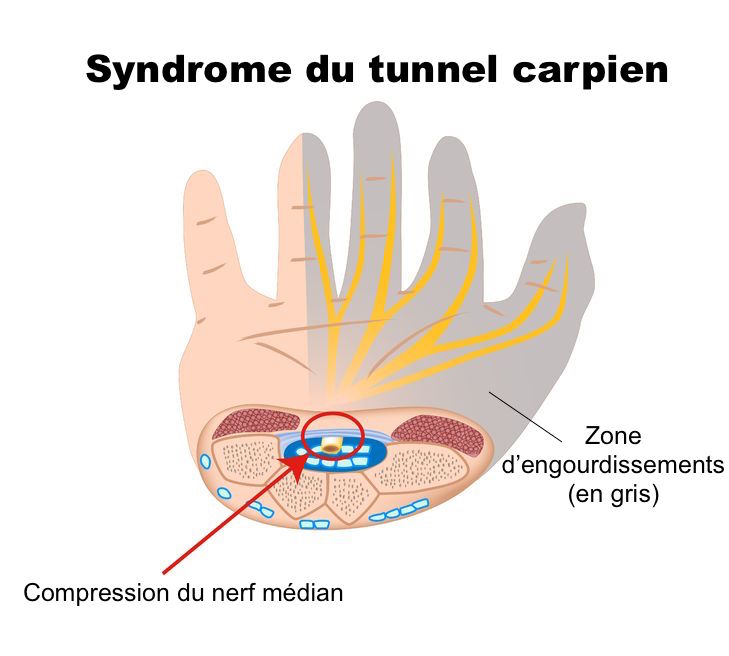 Symptomes tunnel carpien