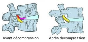 Décompression hernie discale Cox