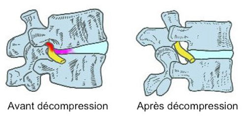 Stenose spinale technique Cox